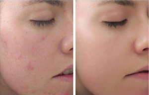 Dịch Vụ Spa Chăm Sóc Da Nhạy Cảm -1 Trải Nghiệm Tinh Tế Cho Làn Da Mỏng Manh 2 screenshot 1720588051