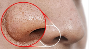 Dịch Vụ Spa Trị Mụn Đầu Đen:1 Giải Pháp Tối Ưu Cho Làn Da Sáng Mịn 1 screenshot 1721400085